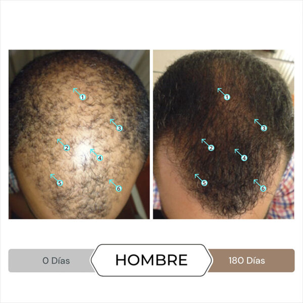 Imagen de comparación antes y después de 180 días de un hombre utilizando el tratamiento Spectral DNC-N para la caída del cabello, mostrando notables mejoras en la densidad y cobertura del cabello en la zona calva